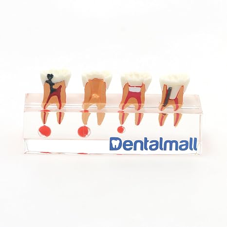 Dental 4-Stage Endodontic Treatment Model for Study Teach Teeth Model 4018 Root Canal Anatomy Demonstration Teaching Tooth Model
