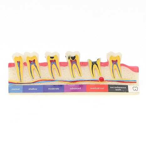 Dental Caries Developing Teeth Model for Study and Teaching Oral Care Education Decoration