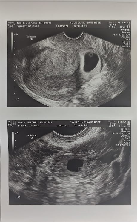 Prank 2D Customized Fake Ultrasound Two Photos Connected B&W